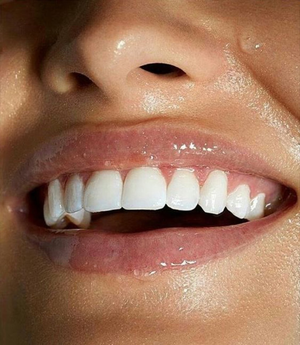 Strass dentaire sourire